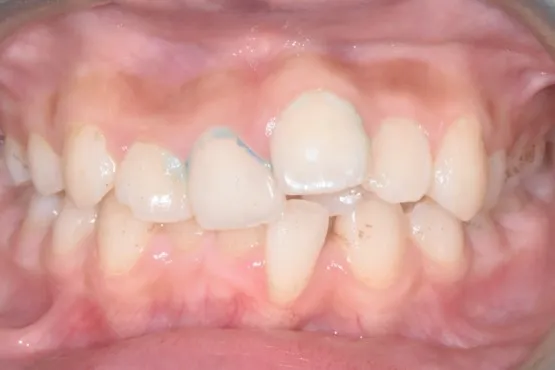 Patient of Nararau2019s Invisalign Makeover