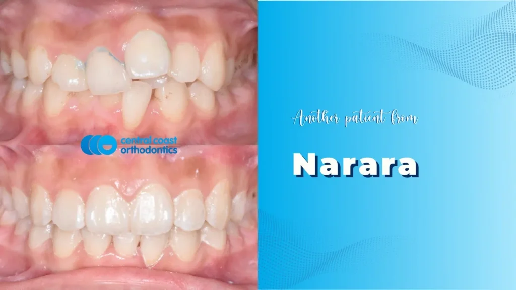 Before and after photographs of a Central Coast Orthodontics patient's teeth, labelled Narara