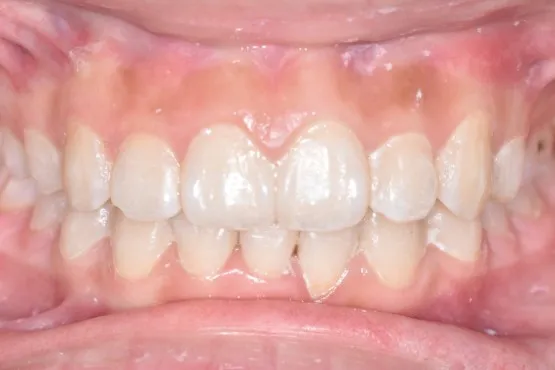 Patient of Nararau2019s Invisalign Makeover