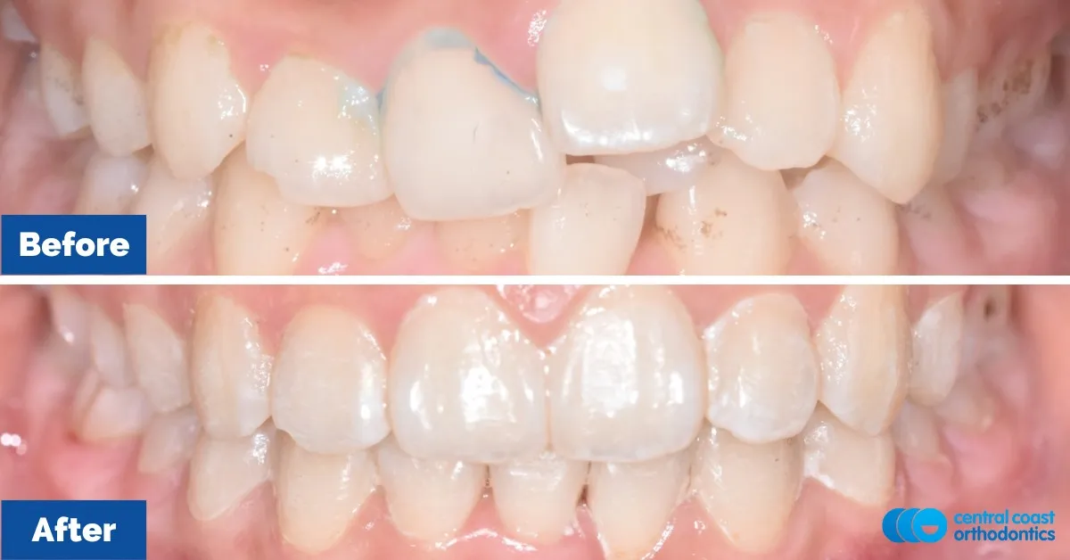 Before and after comparison, front view of the upper and lower teeth