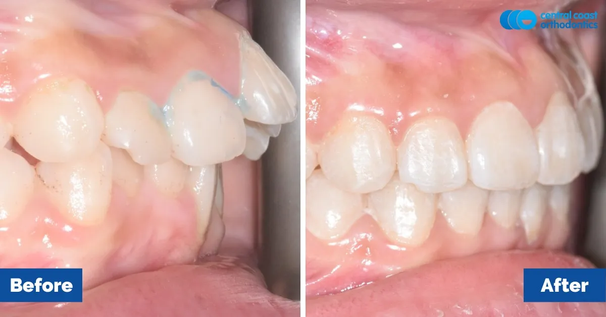 Before and after comparison, side view of the upper and lower teeth