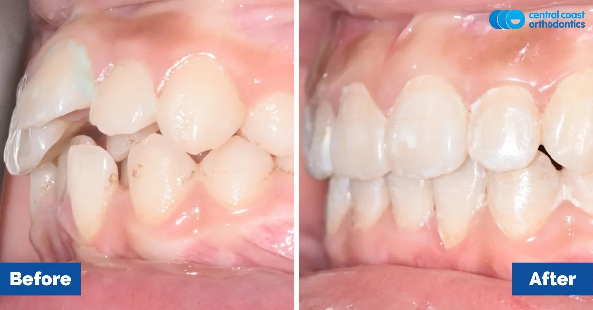 Before and after comparison, side view of the upper and lower teeth