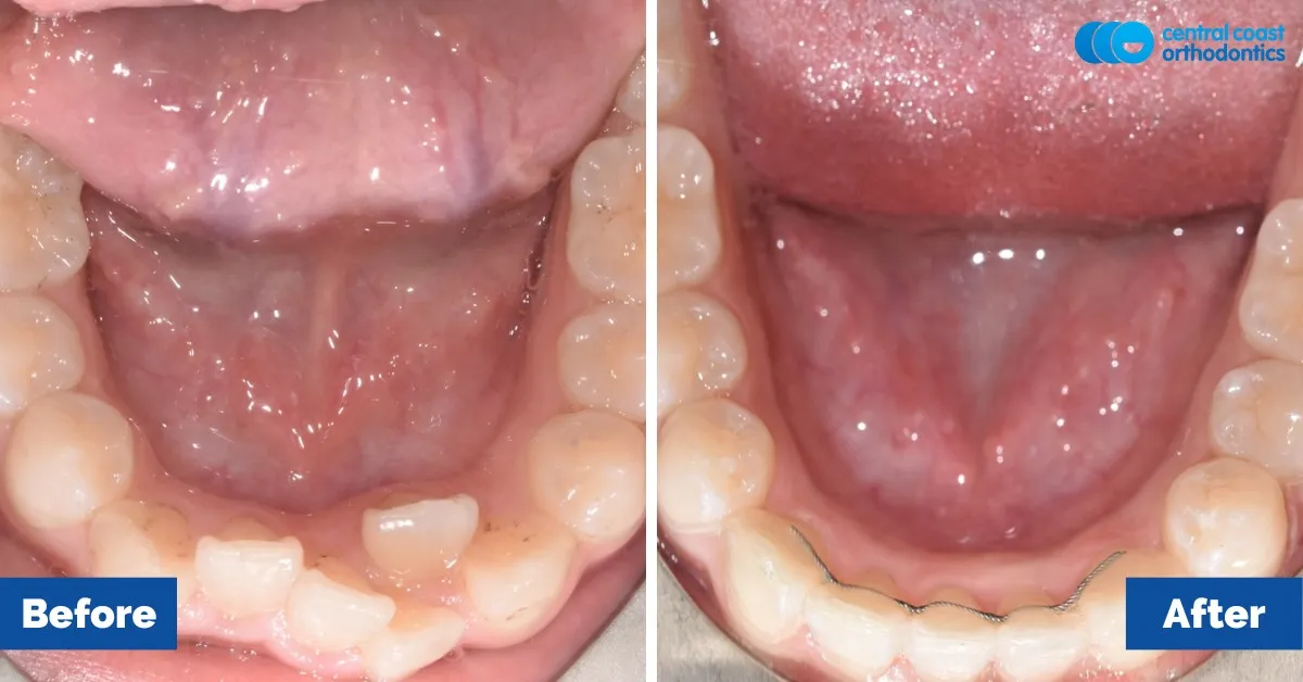 Before and after comparison, lower teeth viewed from above