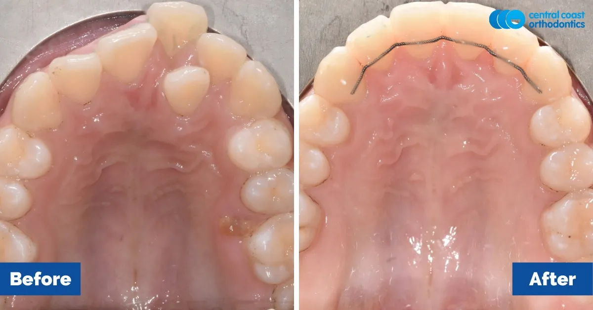 Before and after comparison, upper teeth viewed from below