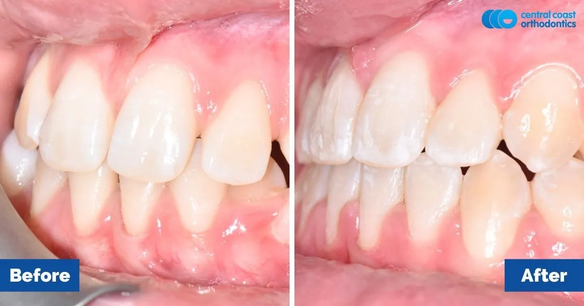 Before and after comparison, side view of the upper and lower teeth