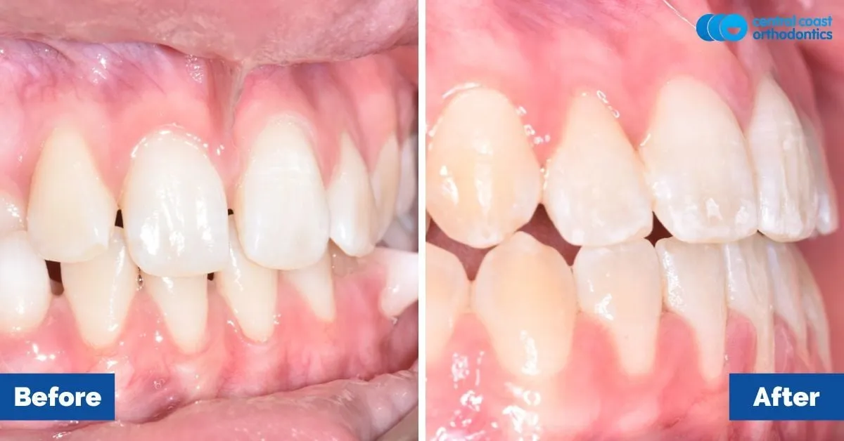 Before and after comparison, side view of the upper and lower teeth