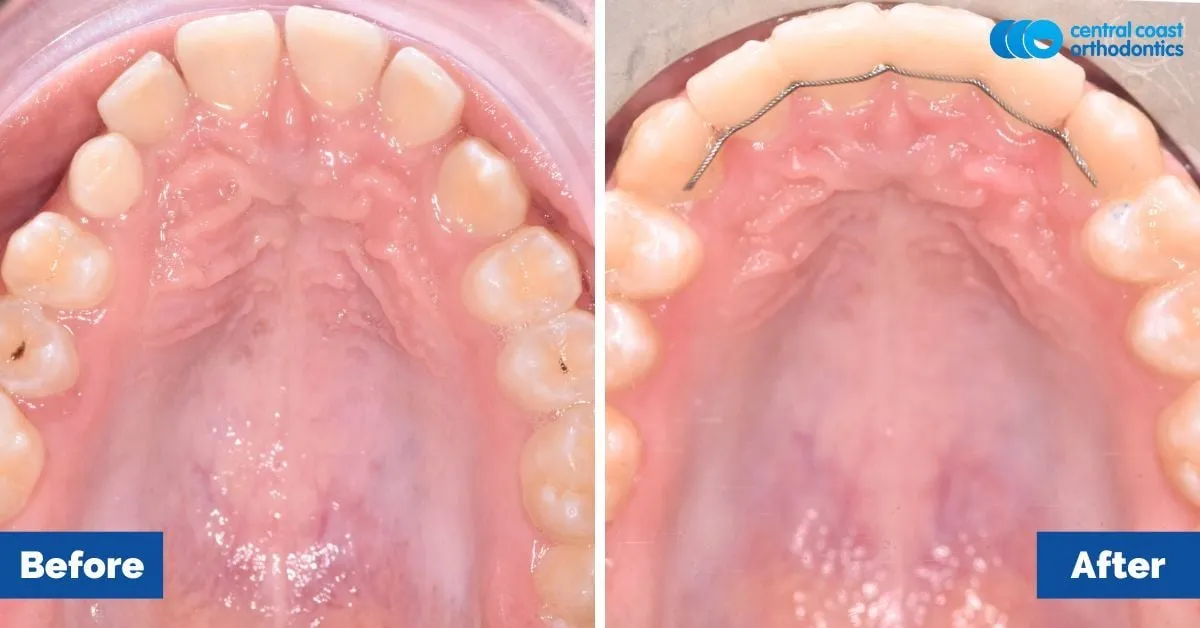Before and after comparison, upper teeth viewed from below