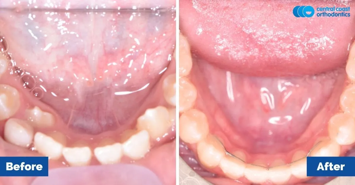 Before and after comparison, lower teeth viewed from above
