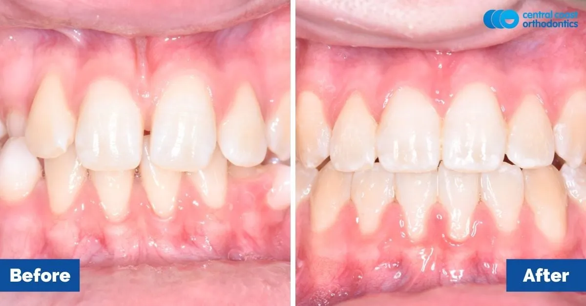 Before and after comparison, front view of the upper and lower teeth