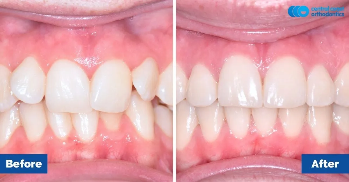 Before and after comparison, front view of the upper and lower teeth