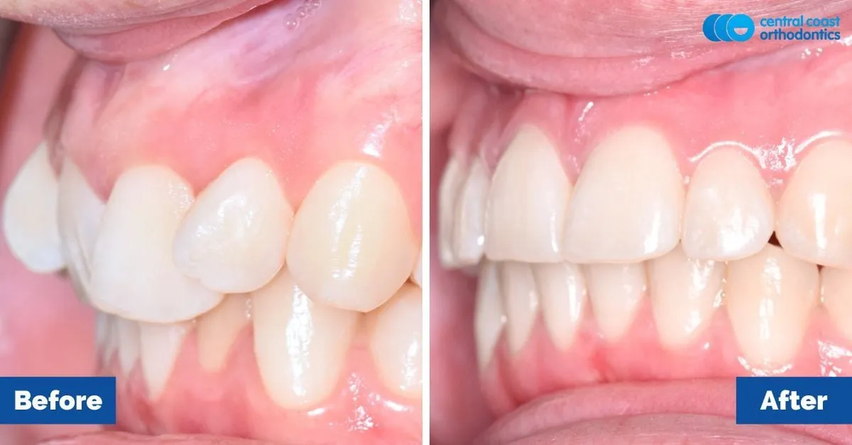 Before and after comparison, side view of the upper and lower teeth