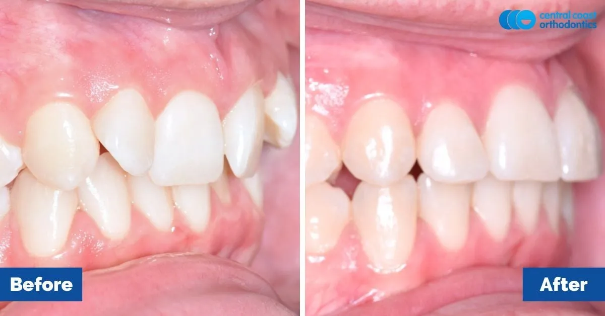 Before and after comparison, side view of the upper and lower teeth