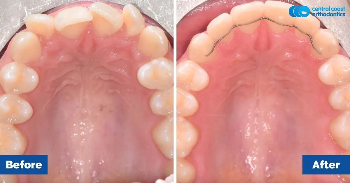 Before and after comparison, upper teeth viewed from below