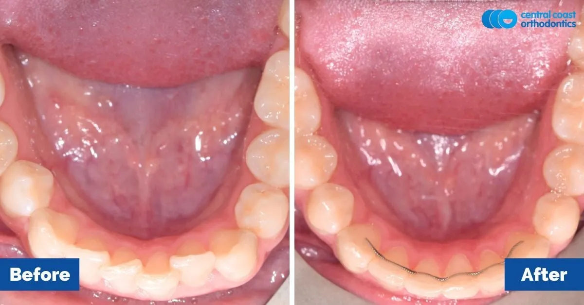 Before and after comparison, lower teeth viewed from above
