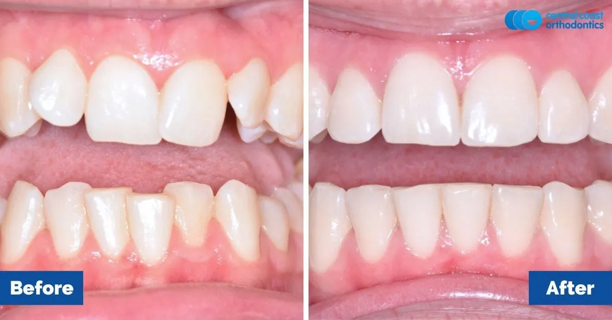 Before and after comparison, front view of the upper and lower teeth