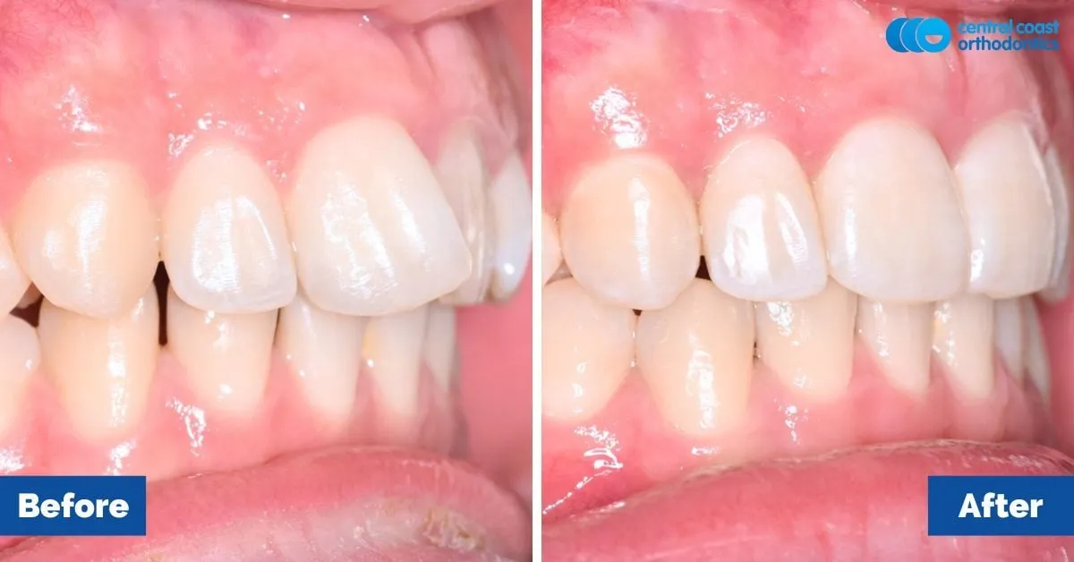 Before and after comparison, side view of the upper and lower teeth