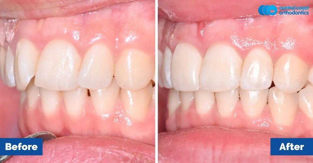 Before and after comparison, front view of the upper and lower teeth