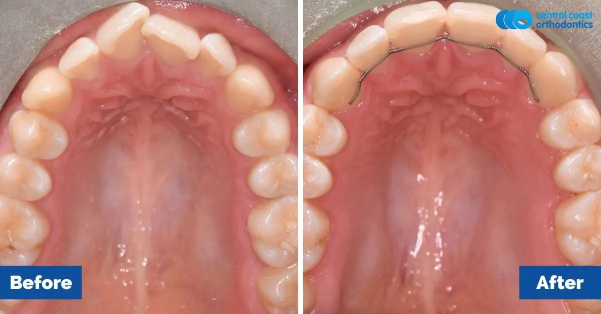 Before and after comparison, upper teeth viewed from below