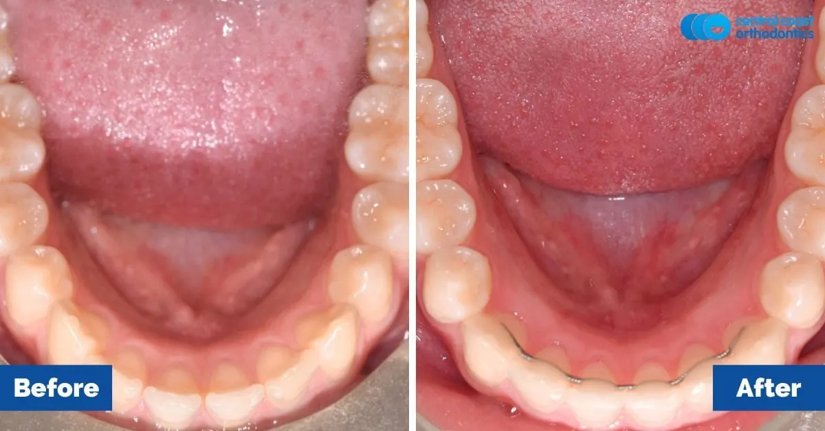 Before and after comparison, lower teeth viewed from above