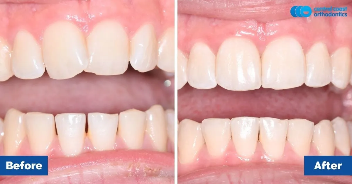 Before and after comparison, front view of the upper and lower teeth