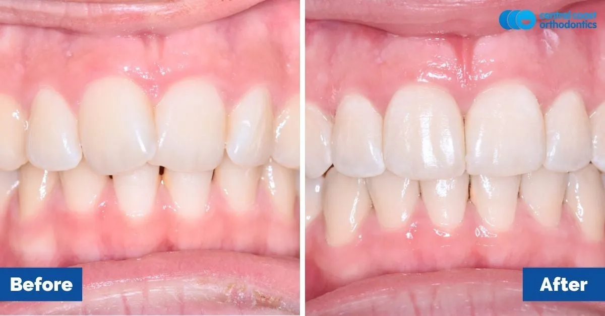 Before and after comparison, side view of the upper and lower teeth