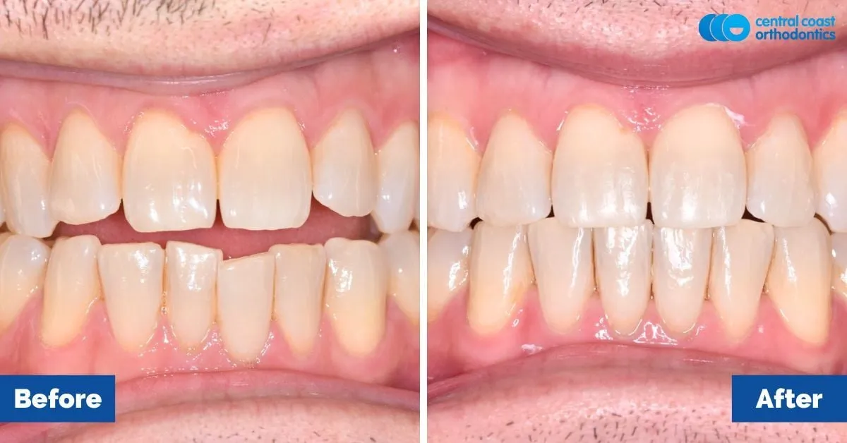 Before and after comparison, front view of the upper and lower teeth