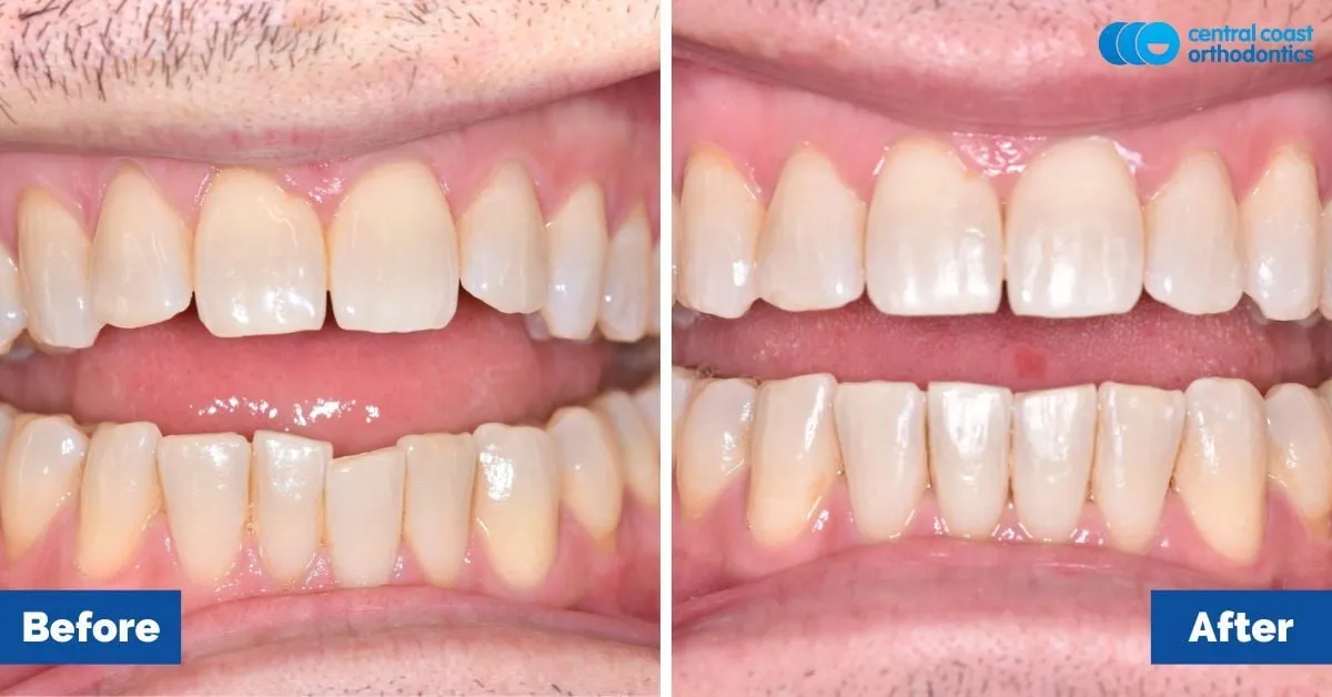 Before and after comparison, front view of the upper and lower teeth