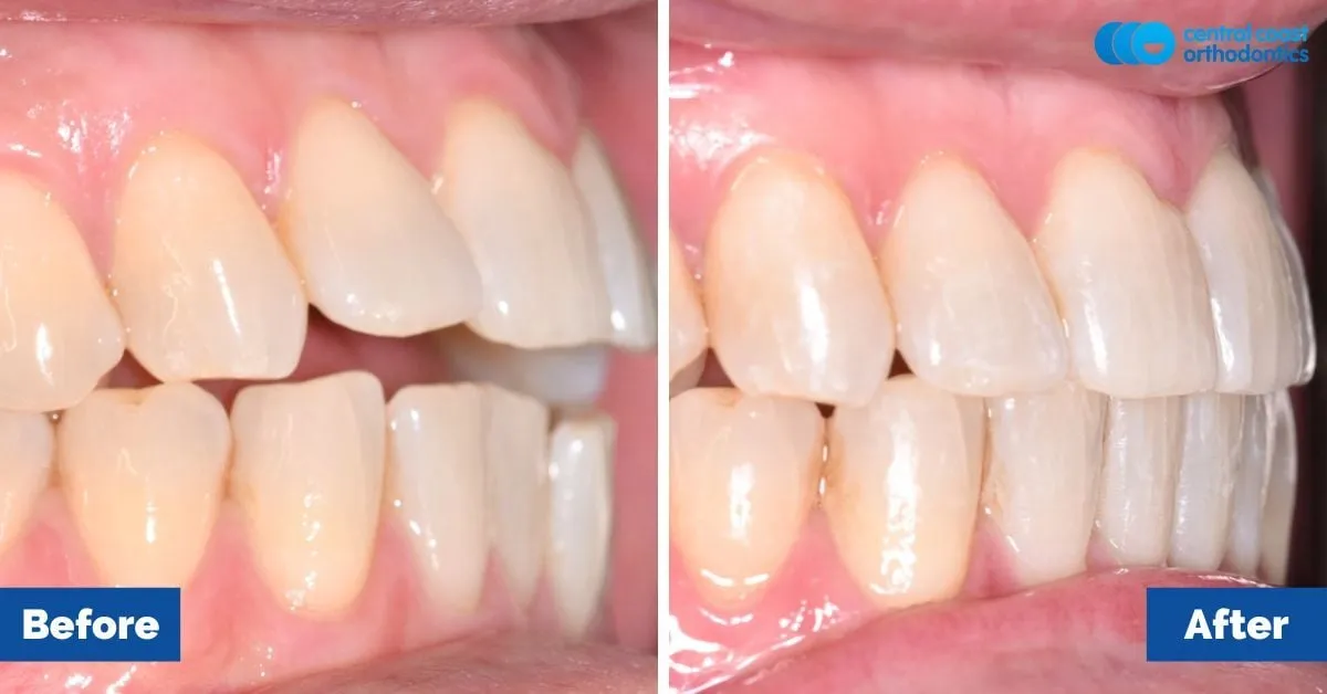 Before and after comparison, side view of the upper and lower teeth