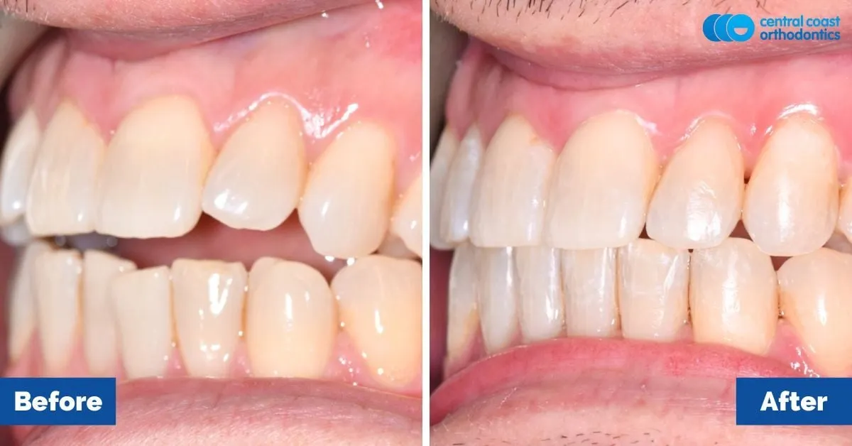 Before and after comparison, side view of the upper and lower teeth