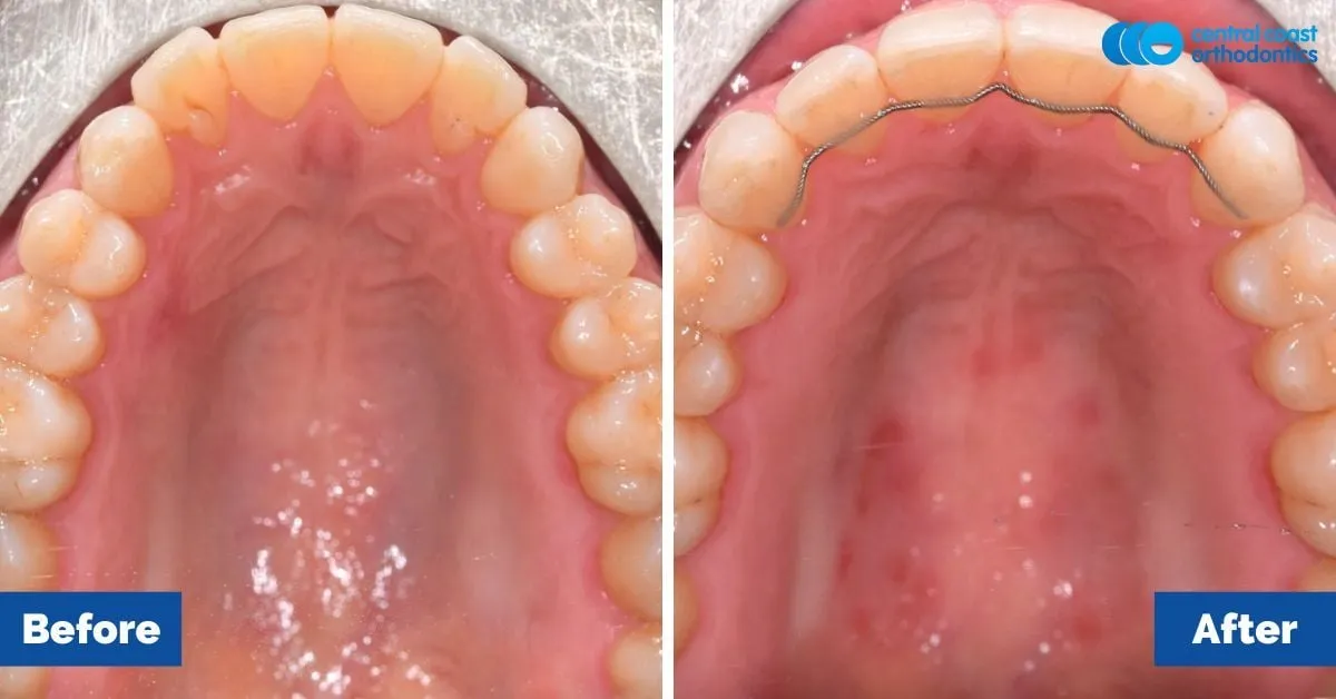 Before and after comparison, upper teeth viewed from below