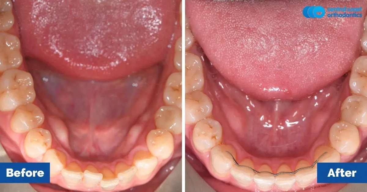 Before and after comparison, lower teeth viewed from above
