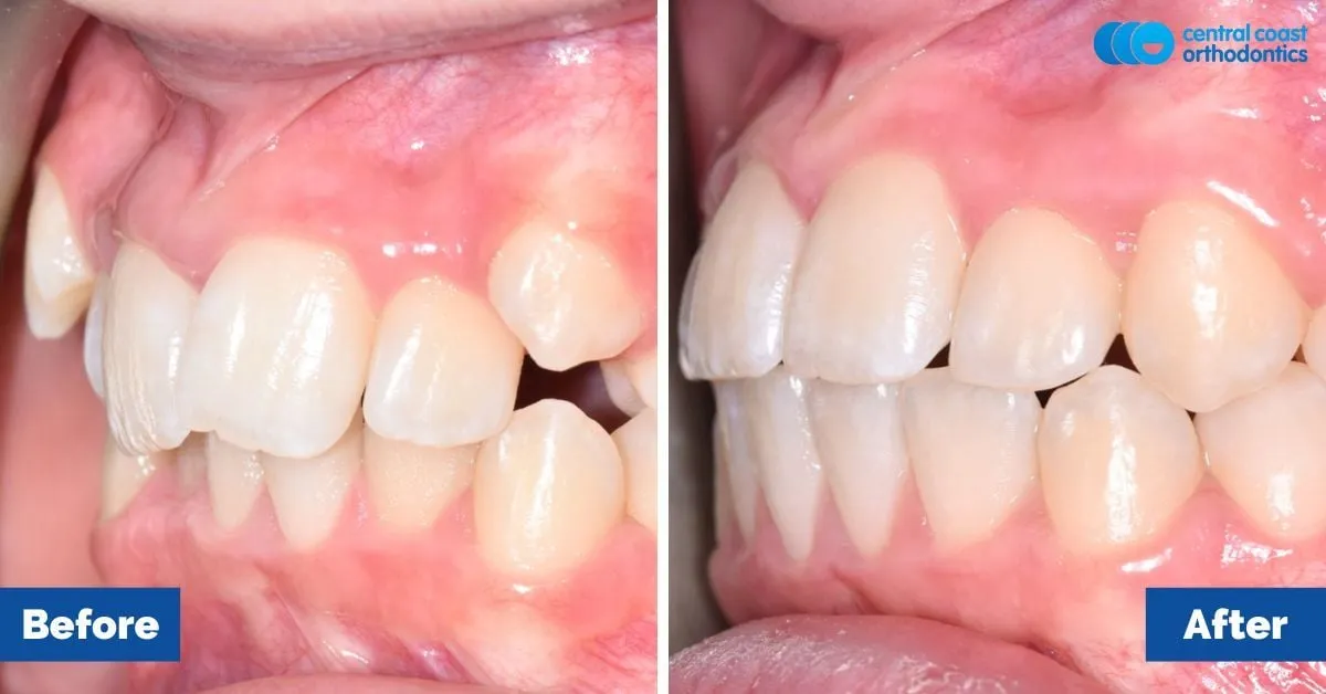 Before and after comparison, side view of the upper and lower teeth