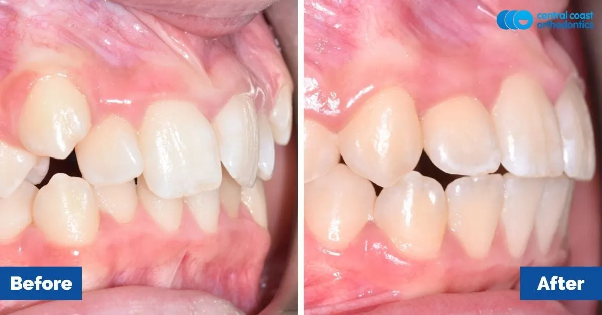 Before and after comparison, side view of the upper and lower teeth