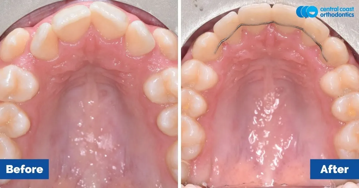 Before and after comparison, upper teeth viewed from below