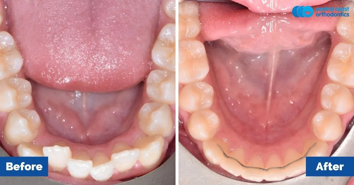 Before and after comparison, lower teeth viewed from above