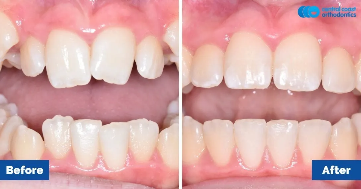 Before and after comparison, front view of the upper and lower teeth