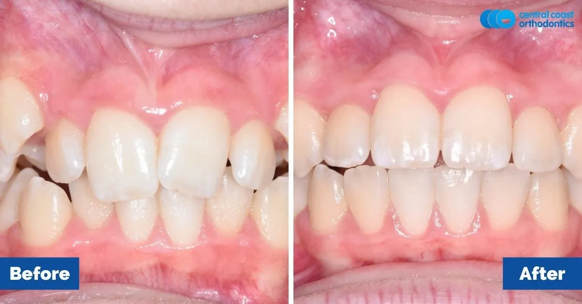 Before and after comparison, front view of the upper and lower teeth