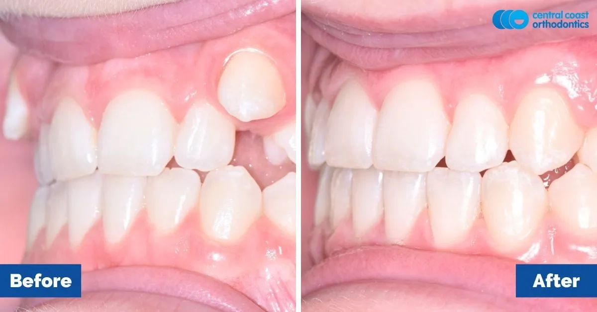 Before and after comparison, side view of the upper and lower teeth