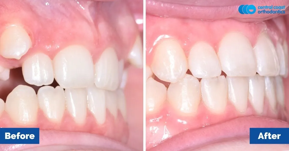 Before and after comparison, side view of the upper and lower teeth