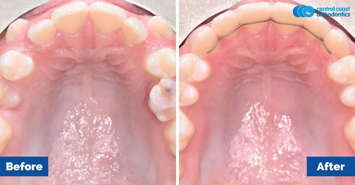 Before and after comparison, upper teeth viewed from below