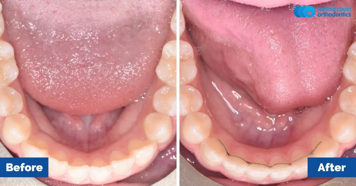Before and after comparison, lower teeth viewed from above