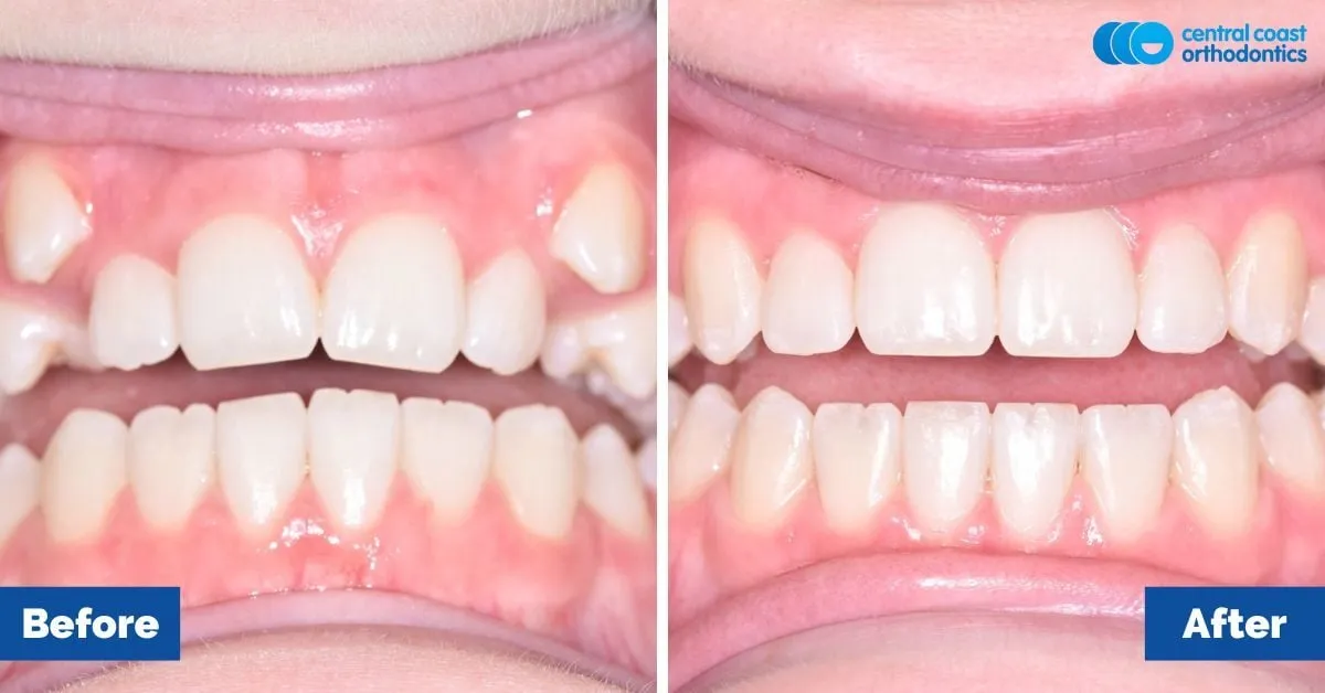 Before and after comparison, front view of the upper and lower teeth