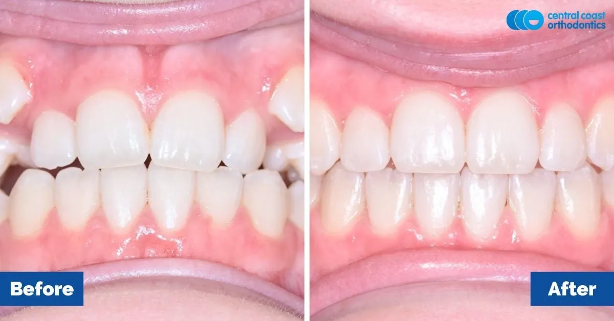 Before and after comparison, front view of the upper and lower teeth