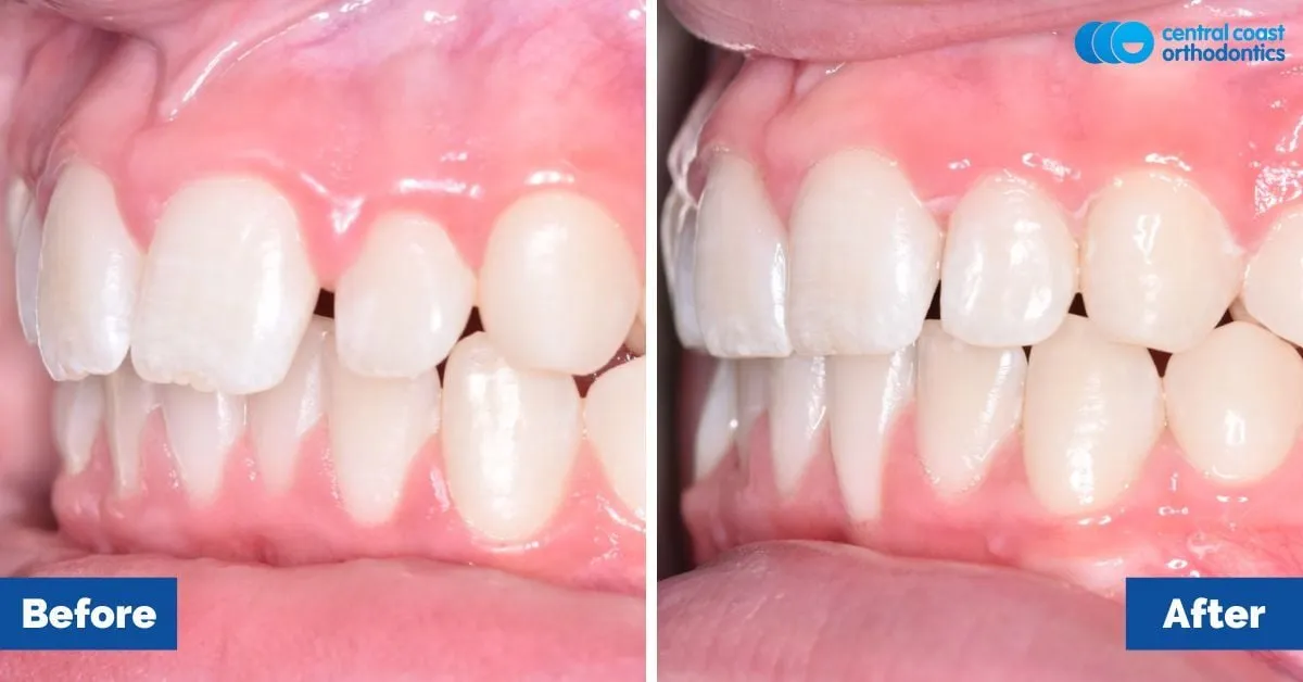 Before and after comparison, front view of the upper and lower teeth