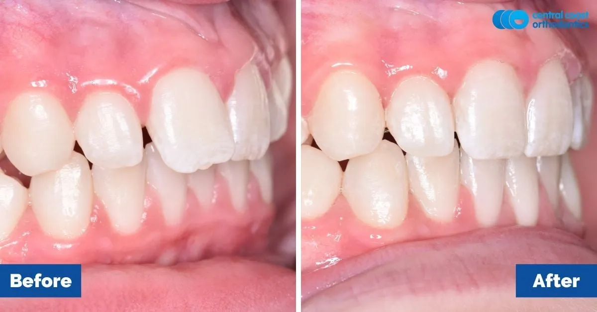 Before and after comparison, front view of the upper and lower teeth