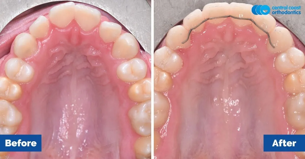 Before and after comparison, upper teeth viewed from below