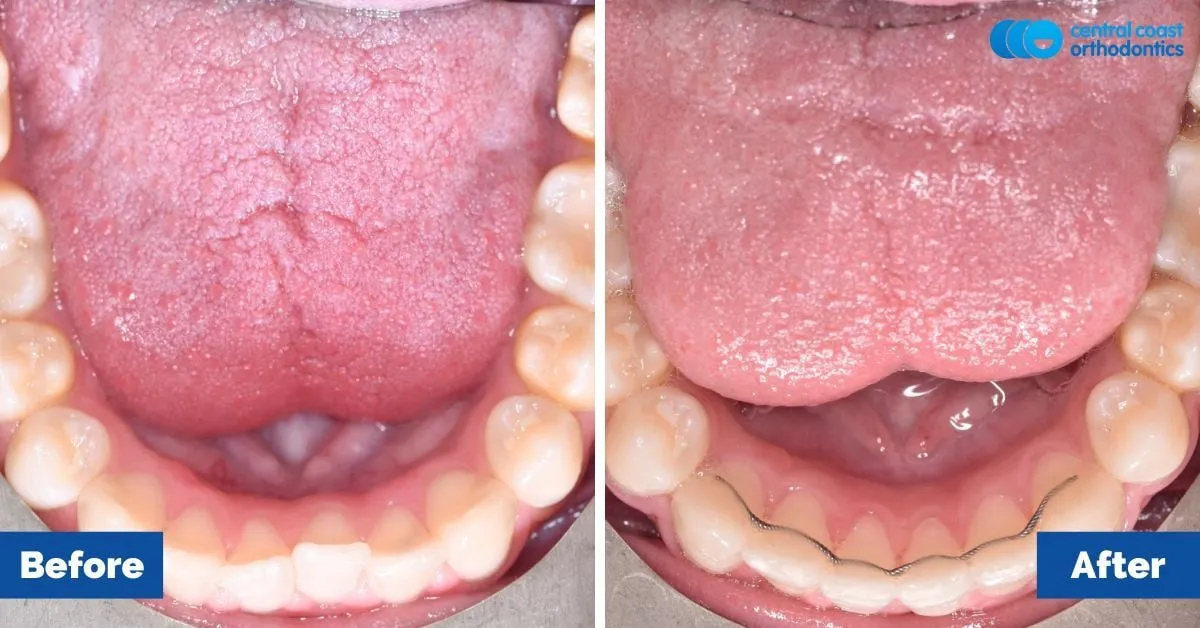 Before and after comparison, lower teeth viewed from above