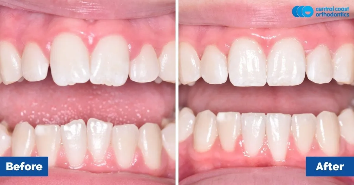 Before and after comparison, front view of the upper and lower teeth