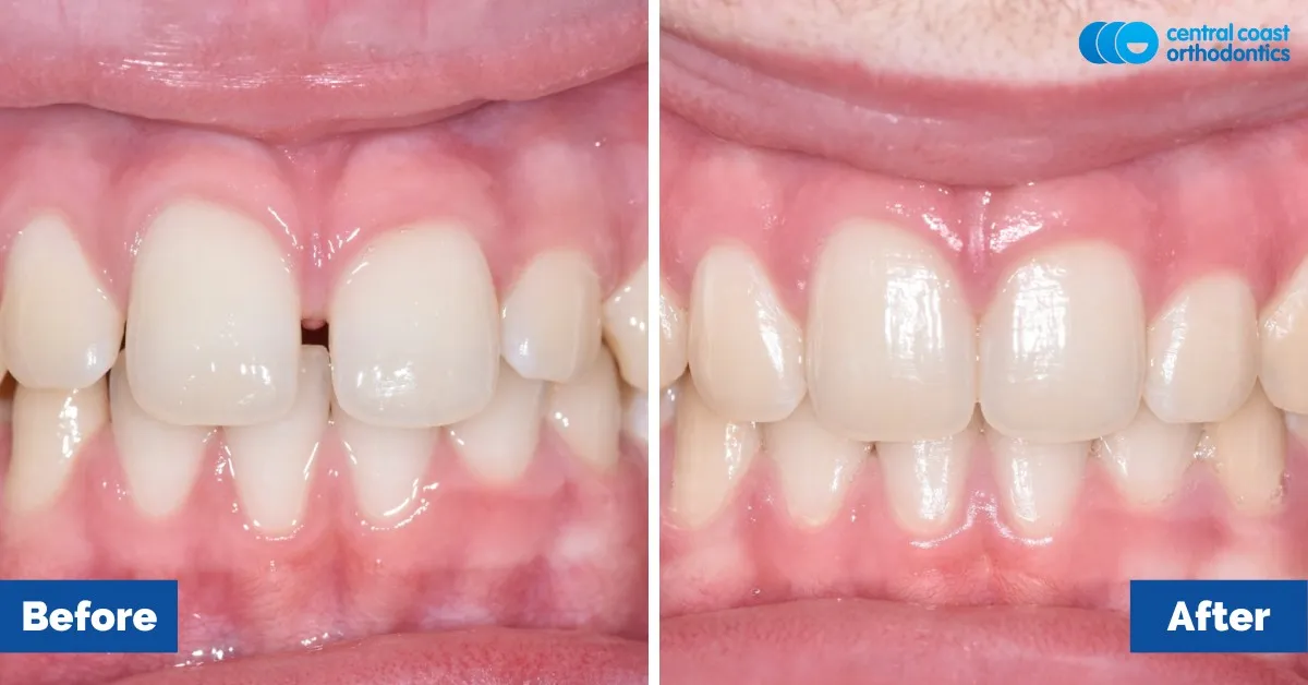 Before and after comparison, front view of the upper and lower teeth