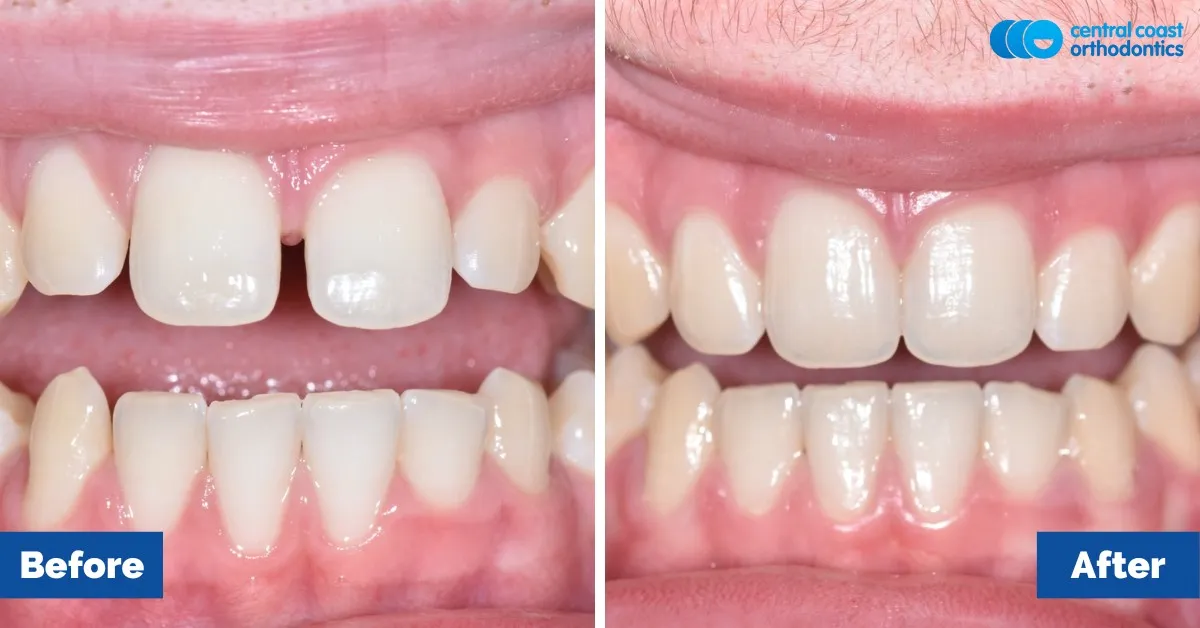 Before and after comparison, front view of the upper and lower teeth